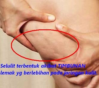 7 Cara Menghilangkan Selulit